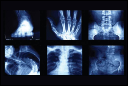 Digital X-Ray Digital X-Ray
